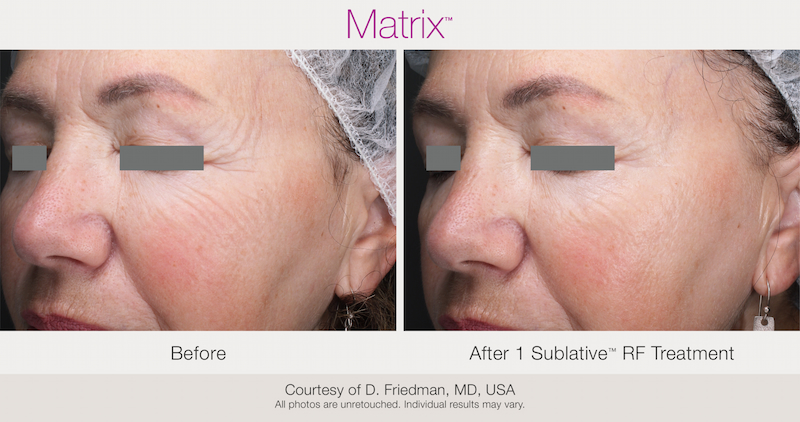 Before and After 1 Sublative RF Treatment