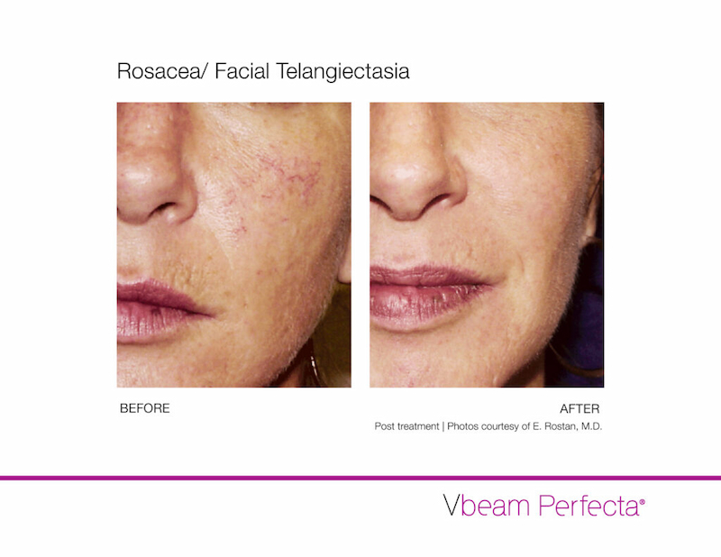 Rosacea/ Facial Telangiectasia Vbeam Perfecta before and after photos