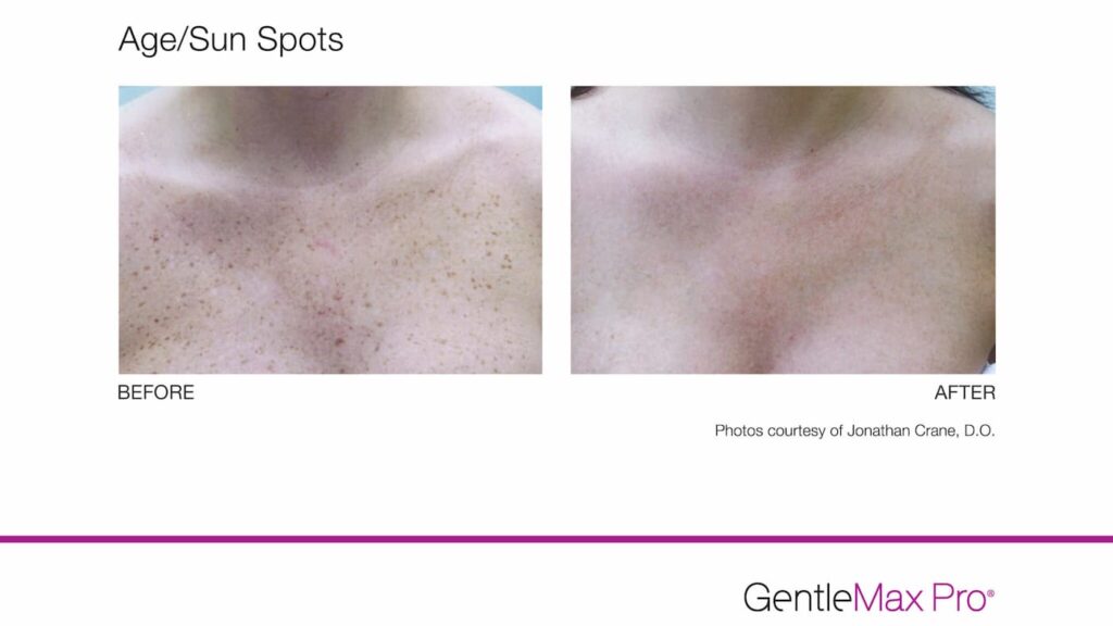 Gentlemax Pro Sunspots
