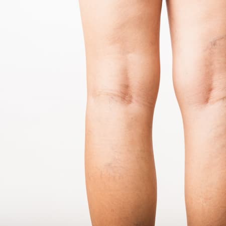 Closeup young Asian woman painful varicose and spider veins on leg, studio shot isolated on white background, Healthcare medical and hygiene skin body varicose veins problems care concept