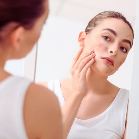 A young woman with problem skin is engaged in her skincare routine, gently touching her face while looking into a mirror in a well-lit, minimalist setting. Concept of acne therapy, scars, inflammation