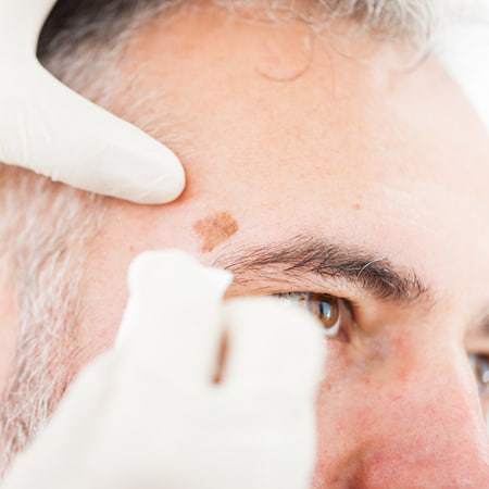 Chryotherapy used to Removed an Aged Spot on Patient Face